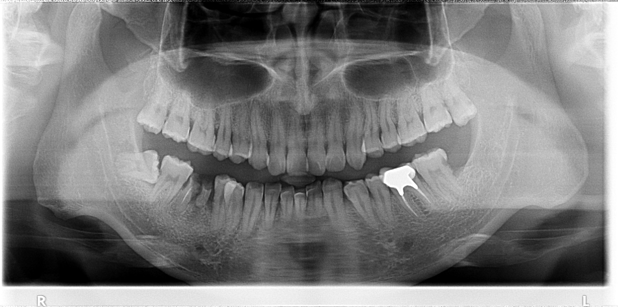 Panoramic x-ray sample
