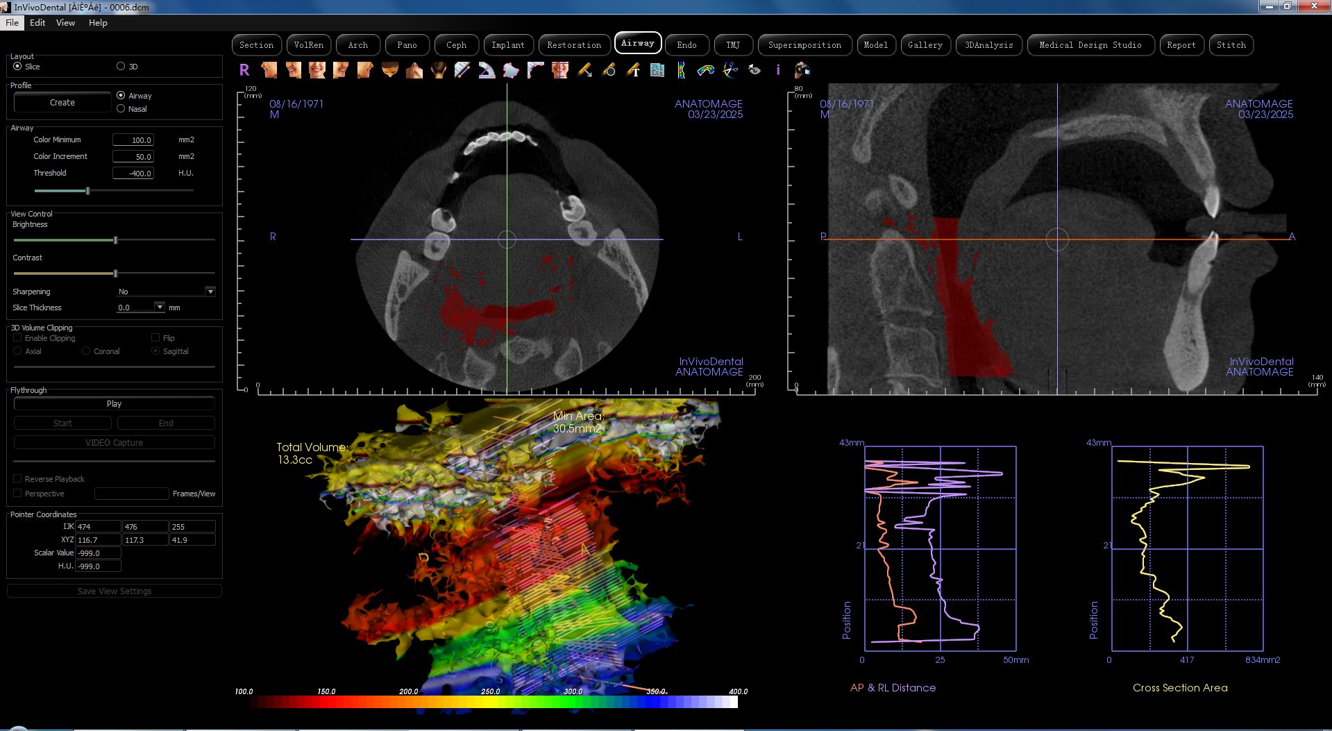 Anatomage airway analysis