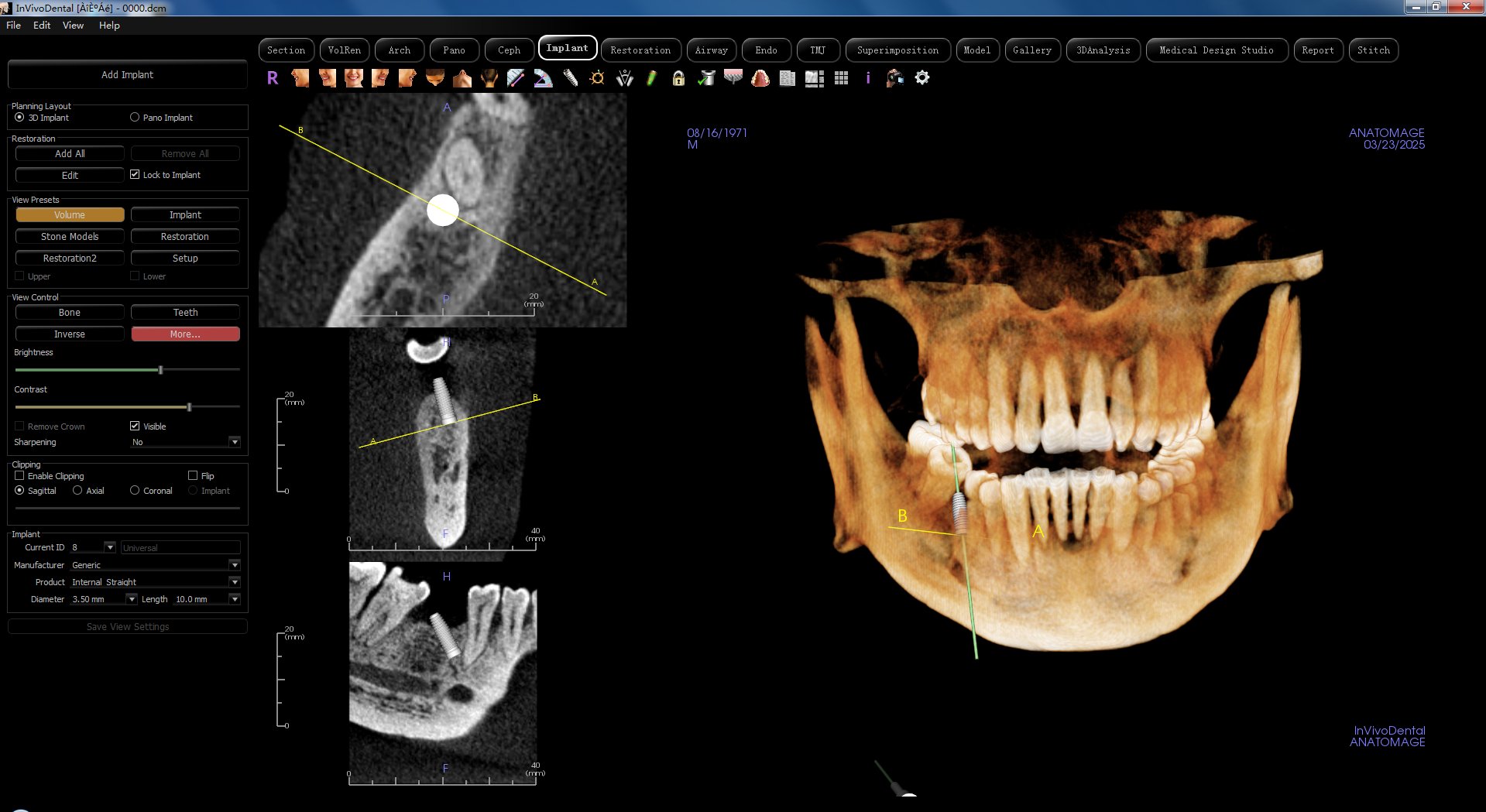 Anatomage implant planning