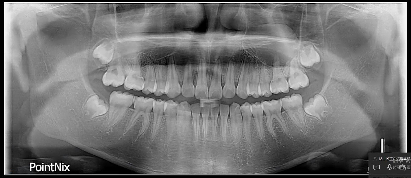 Sample panoramic dental X-ray from PointNix Point 800S HD 3D Plus CBCT — full adult dentition showing clear roots, periodontal ligament space, third molars, mandibular canal and maxillary sinus floor. PointNix watermark visible.